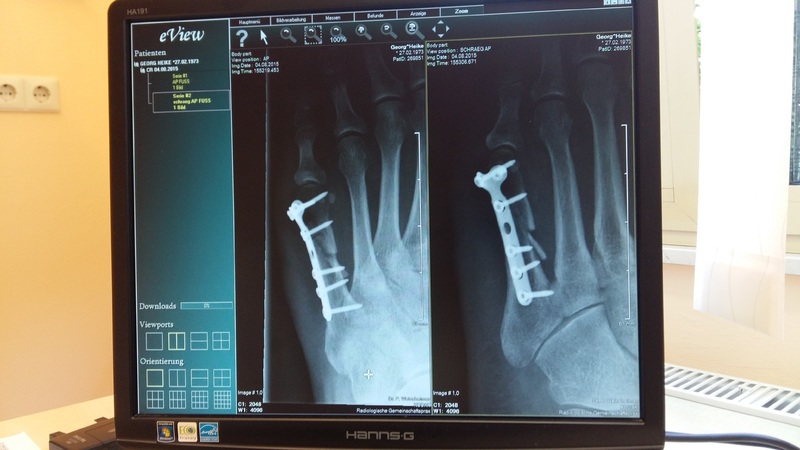 Врачи рассказали о сложностях, связанных с реабилитацией пациентов с травмами и ампутациями