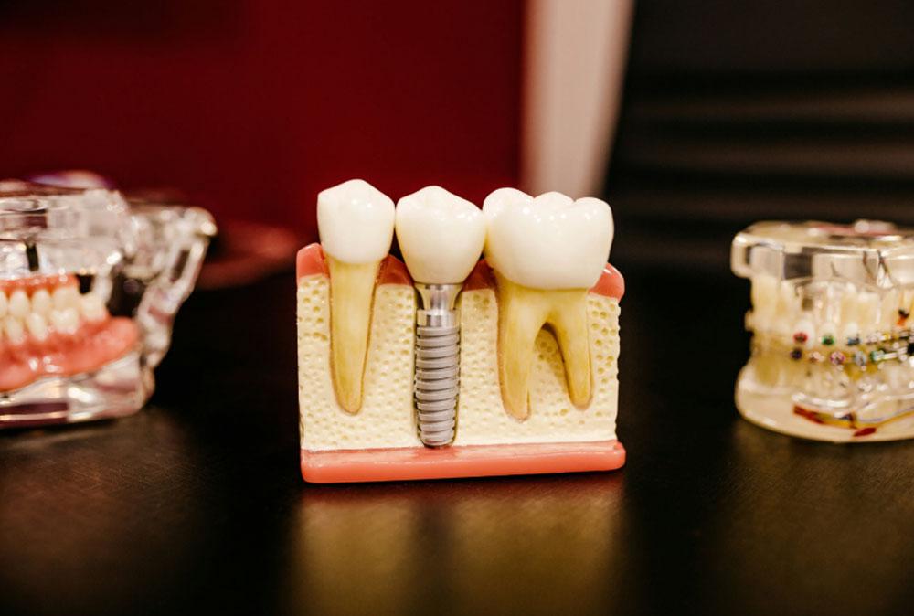 Новый имплант без боли и риска осложнений: как это работает | Учёные создали биоматериал, который изменит зубные импланты навсегда