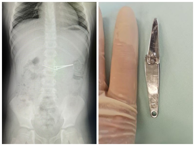 Съел щипцы: в Уфе врачи вытащили острый предмет из желудка шестилетнего мальчика | Шестилетний мальчик в Уфе проглотил щипцы, но выжил