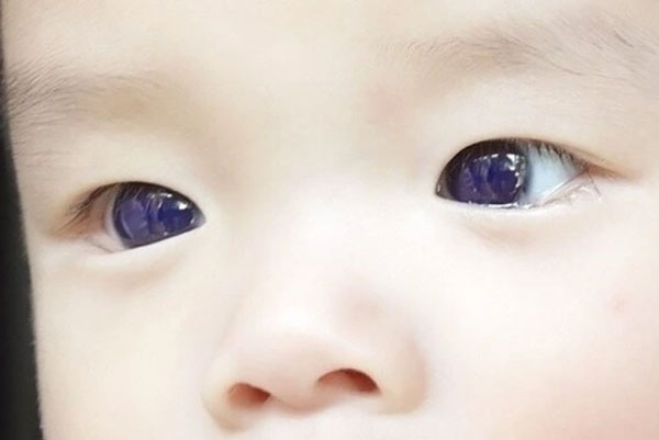 В Таиланде глаза шестимесячного малыша стали фиолетовыми, отреагировав на лекарство от ковида