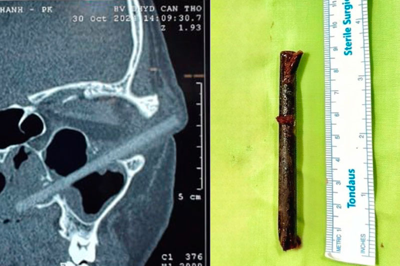 Во Вьетнаме мужчина три недели ходил с 9-сантиметровой палочкой в глазу и не замечал этого | Во Вьетнаме парень три недели не замечал палочку в глазу