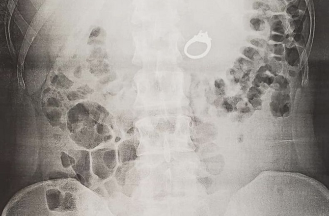 Американка проглотила во сне обручальное кольцо