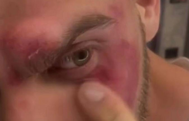 Фитнес-тренер в Мытищах получил травму лица от штанги весом 100 кг | В Мытищах тренер уронил штангу себе на лицо во время жима