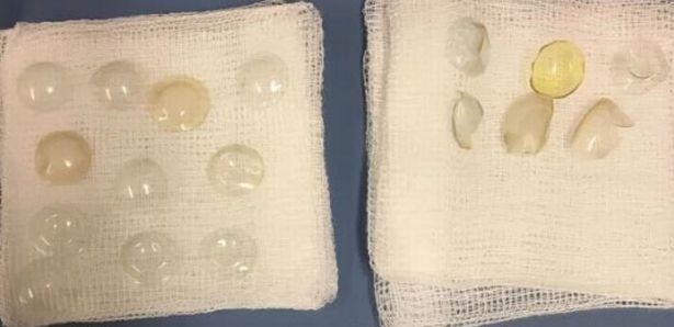 В глазу у британки обнаружили 27 потерявшихся линз