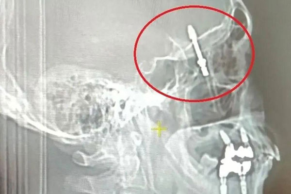 Зубная драма: как имплант врача оказался в мозге пациента | В Турции стоматолог завинтил зубной имплант в мозг пациента 