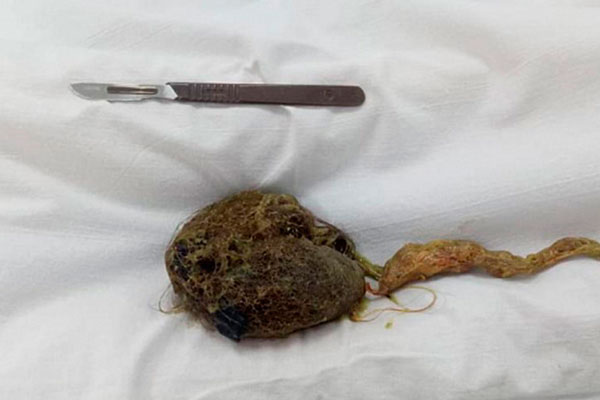 В Кирове врачи извлекли из желудка девочки 300-граммовый ком волос