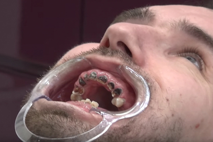 Зависимый от газировки ирландец показал гнилую улыбку