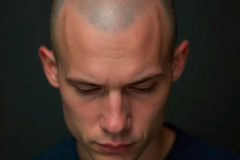 Эпидемия облысения среди подростков в России: "В 15 лет уже третья стадия алопеции!" — тревожные данные врачей | Mash: российские подростки стали чаще сталкиваться с проблемой облысения