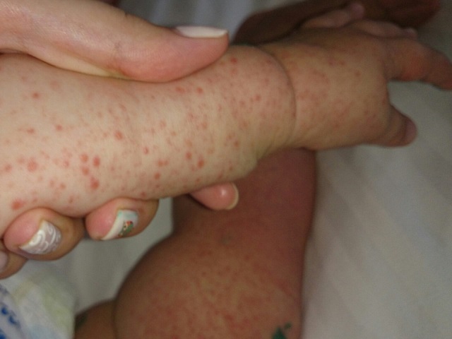 Годовалый челябинец подхватил в Турции вирус коксаки